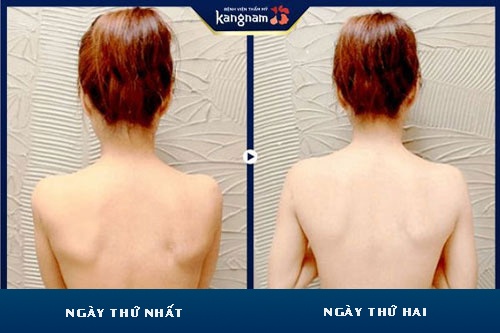 Da sau tắm trắng đang trong giai đoạn hồi phục cách chăm sóc da sau tắm trắng