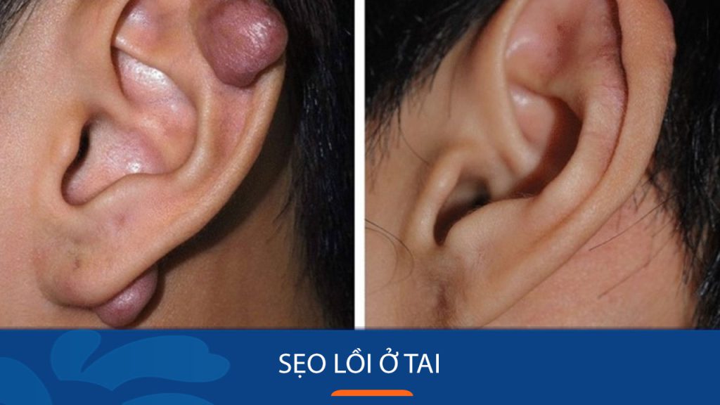 Cách chữa sẹo lồi ở tai: Loại bỏ sẹo lồi ở tai dứt điểm