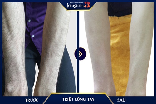 cách tẩy lông tay không mọc lại 