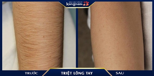 cách tẩy lông tay