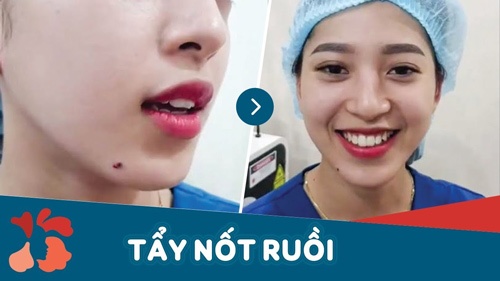 Kangnam đang áp dụng công nghệ tẩy nốt ruồi hiện đại cho kết quả tối ưu nhất