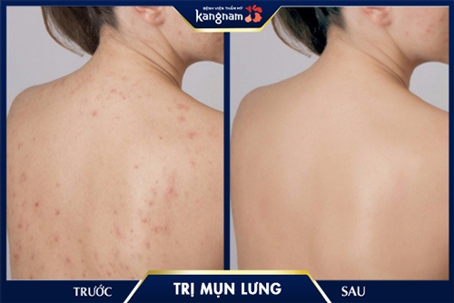 hiệu quả trị mụn nano skin Kết quả khách hàng sau khi điều trị mụn lưng tại Kangnam