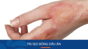 3 Cách trị sẹo bỏng dầu ăn Cấp Tốc – Nên dùng gì để trị sẹo bỏng dầu ăn?