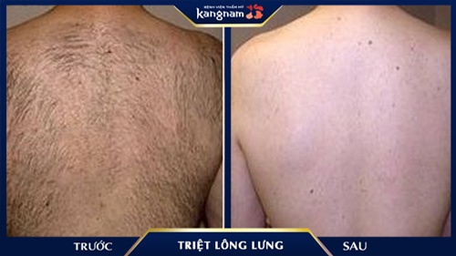 Hình ảnh kết quả sau khi tẩy lông lưng thành công đến 99% cách triệt lông lưng