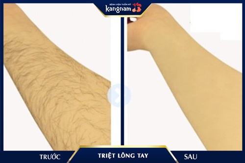 cách triệt lông tay