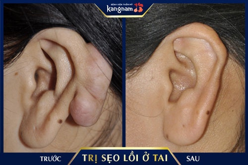 khám sẹo lồi ở tai