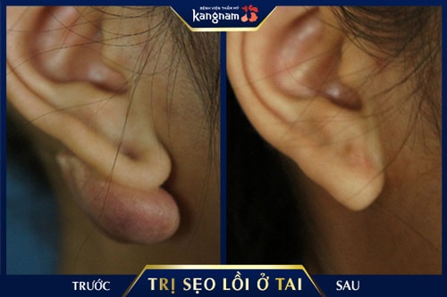 trị sẹo lồi ở vành tai 