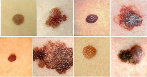 giá tẩy nốt ruồi Kích thước nốt ruồi cũng sẽ ảnh hưởng tới chi phí