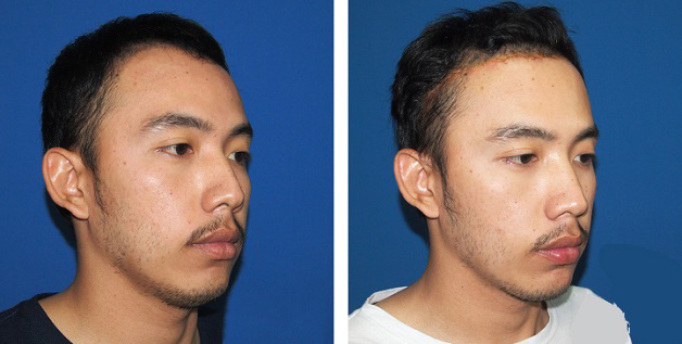 Anh Nam hạ trán cao dô cải thiện gương mặt