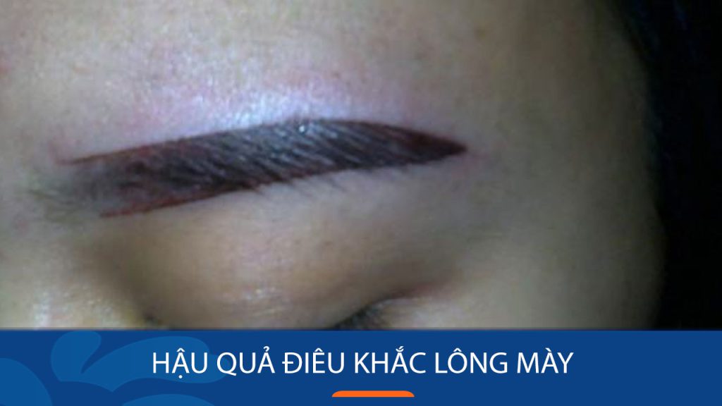 Điêu khắc lông mày “Hỏng” – Nên làm gì khi gặp biến chứng?