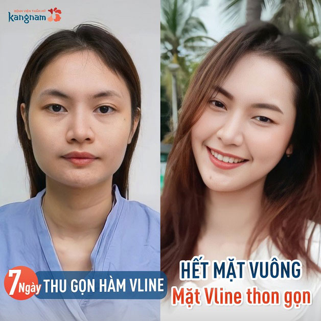 Mặt vuông có nên độn cằm?