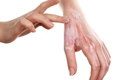 Sử dụng thuốc trị sẹo bỏng giúp đẩy lùi các vết sẹo bỏng dạng nhẹ