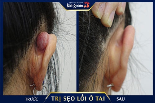 bị sẹo lồi ở tai