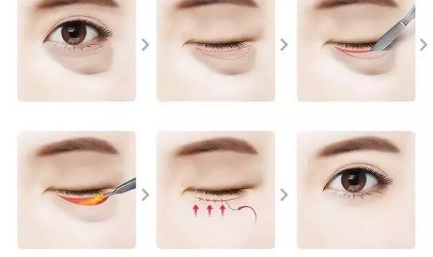 Lấy mỡ bọng mắt có thời gian lành khoảng từ 2 - 6 tuần