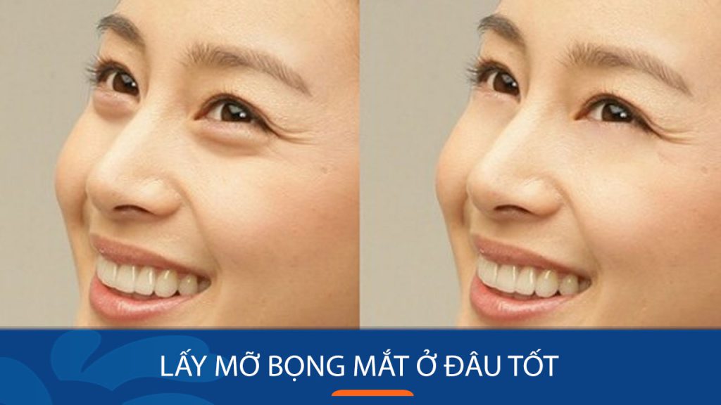 Lấy mỡ bọng mắt ở đâu tốt? Top 5 địa chỉ lấy mỡ mí mắt uy tín