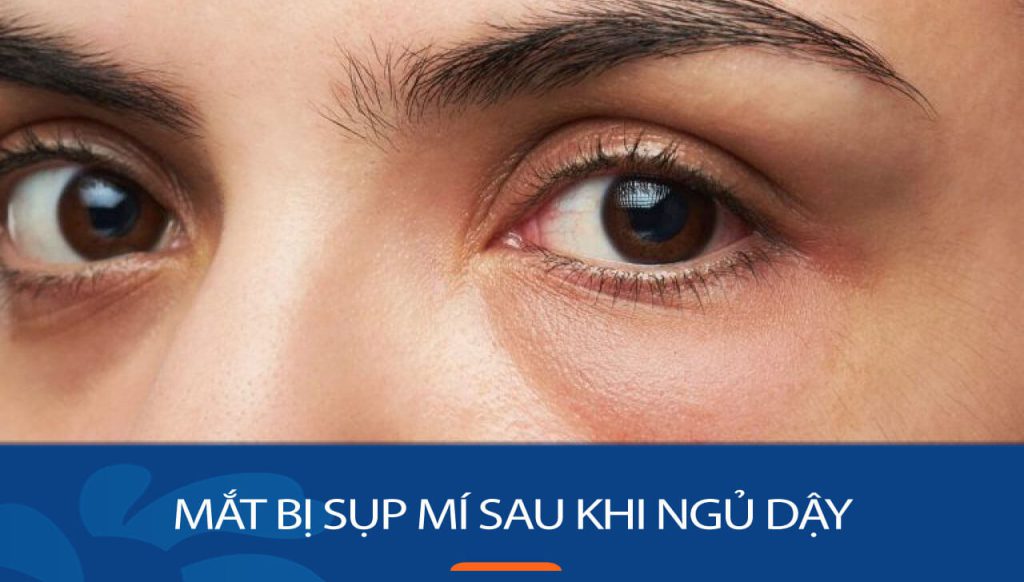 Mắt bị sụp mí sau khi ngủ dậy: Nguyên nhân & cách khắc phục hiệu quả