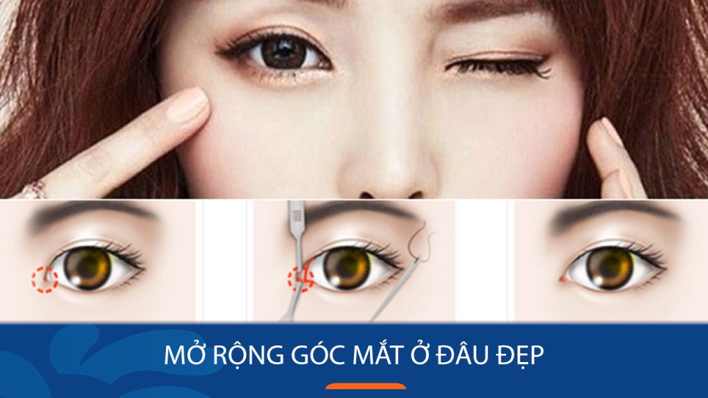 Mở rộng góc mắt ở đâu đẹp? Địa điểm uy tín