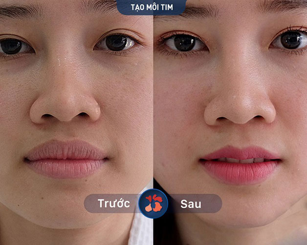 Khách hàng sở hữu môi trái tim xinh xắn, dễ thương chuẩn gái Hàn sau thẩm mỹ môiKhách hàng sở hữu môi trái tim xinh xắn, dễ thương chuẩn gái Hàn sau thẩm mỹ môi