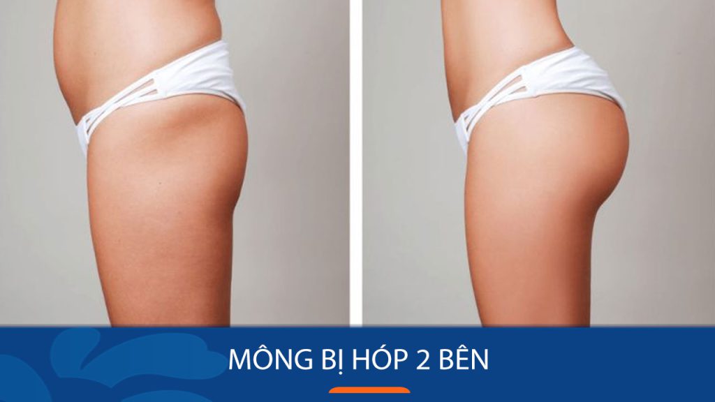Mông bị hóp 2 bên khắc phục đơn giản với 7 bài tập
