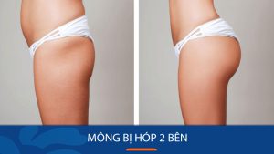 Mông bị hóp 2 bên khắc phục đơn giản với 7 bài tập