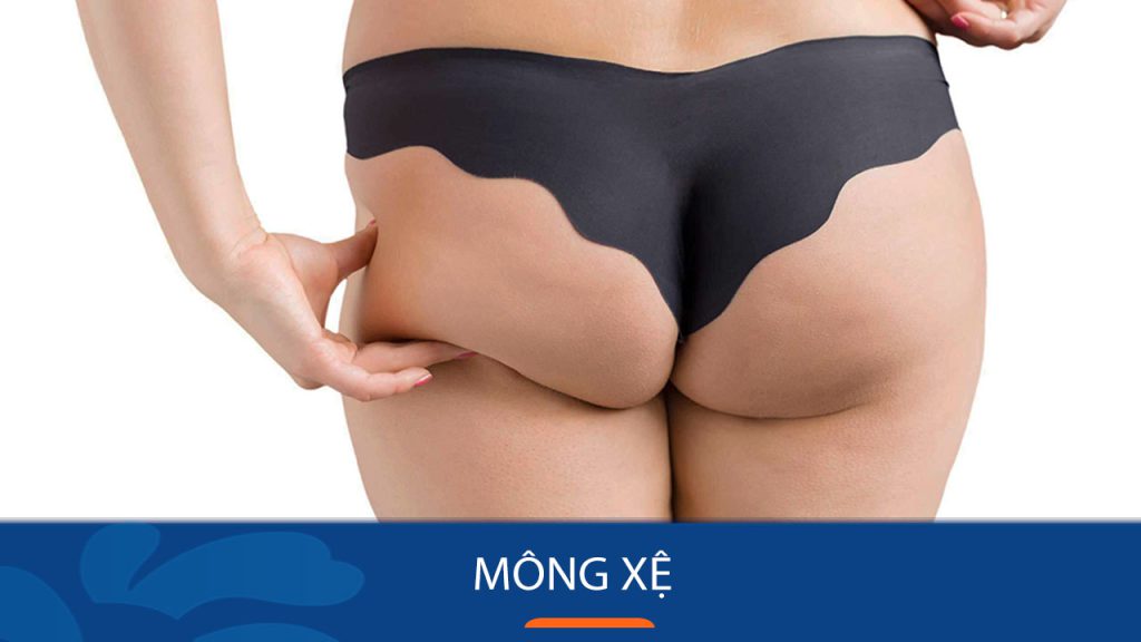 Mông xệ – Nguyên nhân và cách khắc phục