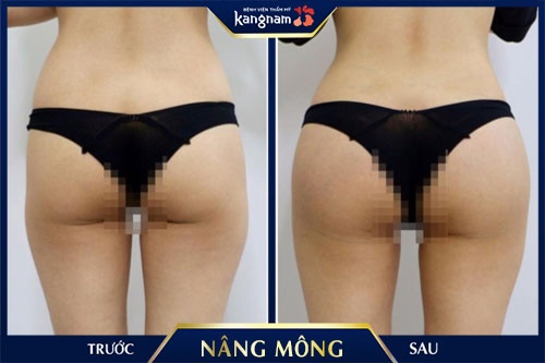 mông bị xệ phải làm sao