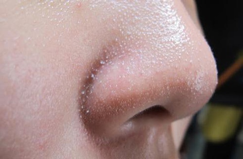 mụn bọc đầu mũi