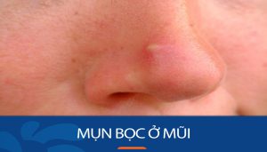 Mụn Bọc Mũi: Giải mã nguyên nhân & Bí quyết trị mụn DỨT ĐIỂM