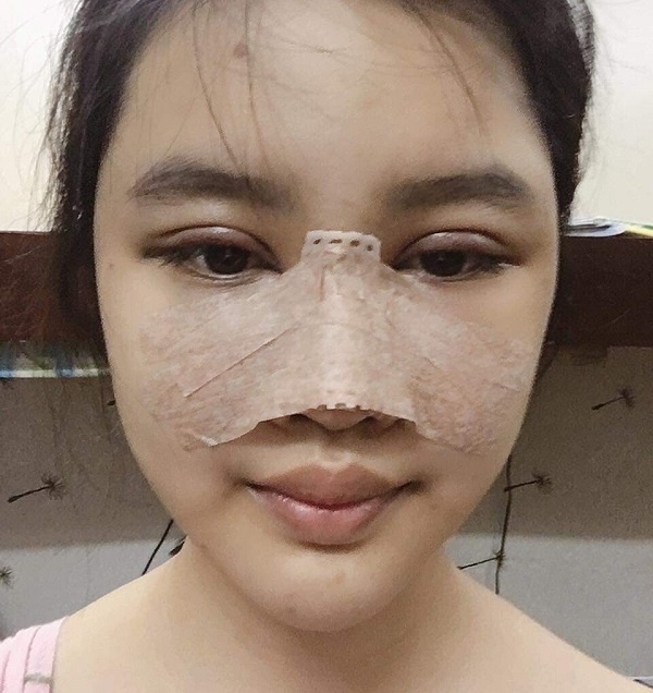 nâng mũi bị kéo mắt phải làm sao