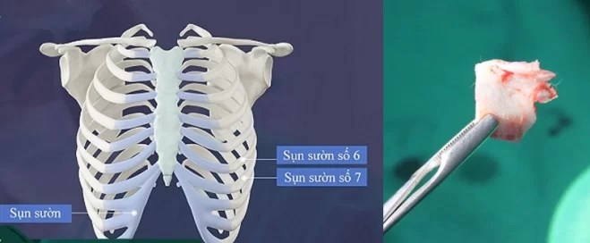 nâng mũi bị kéo mắt