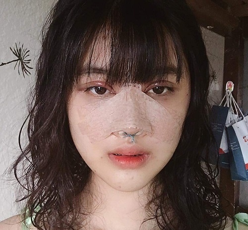 Sưng tấy khuôn mặt khiến nụ cười không được tự nhiên, đơ cứng nâng mũi cười bị đơ