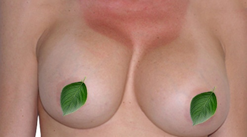 Trường hợp ngực cứng đờ và méo xệch có thể là biểu hiện của biến chứng co thắt bao xơ nâng ngực bao lâu thì mềm tự nhiên