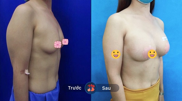 Vòng 1 thay đổi sau khi nâng ngực