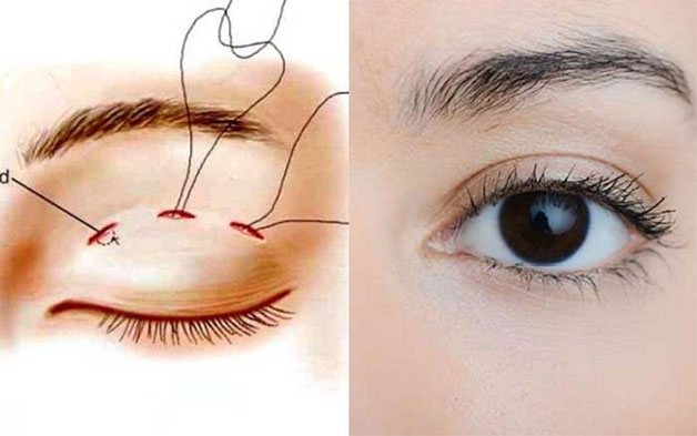 Nhấn mí mắt giữ được bao lâu?