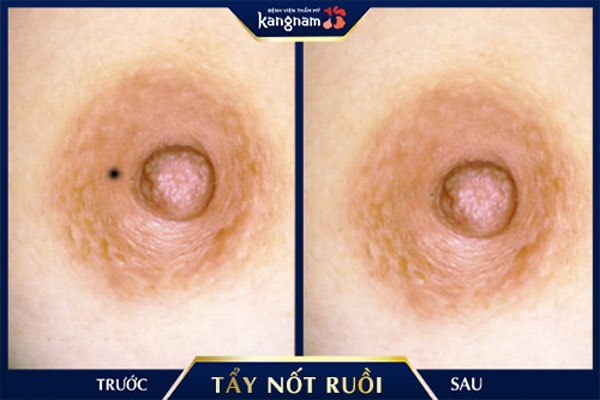 nốt ruồi ở quầng nhũ hoa nốt ruồi ở quầng nhũ hoa