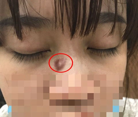 phá nốt ruồi có nguy hiểm không