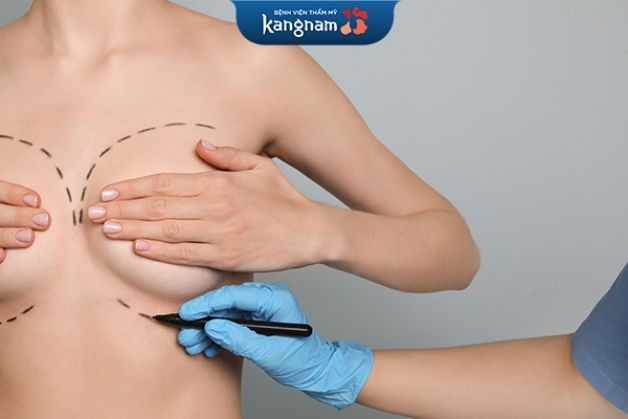 Phẫu thuật nâng ngực chuẩn đẹp