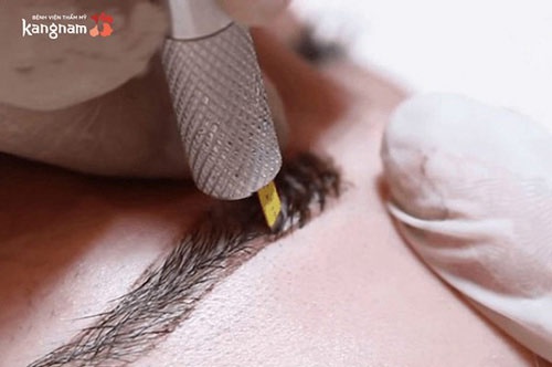 phun lông mày bị sưng