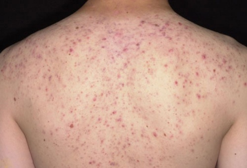 Tình trạng mụn lưng nặng khó có thể chữa khỏi bằng phương pháp tự nhiên từ muối Tình trạng mụn lưng nặng khó có thể chữa khỏi bằng phương pháp tự nhiên từ muối