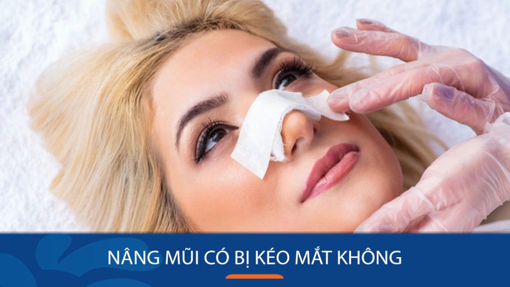 Nâng mũi có bị kéo mắt không? Khi nào có thể xảy ra?
