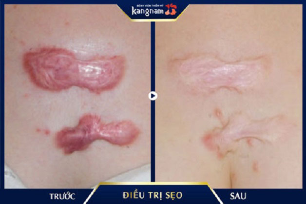 Tiêm trị sẹo lồi sau khi bị tai nạn khâu mổ