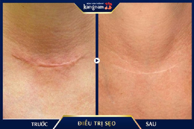 Vết sẹo lâu năm trên lưng mờ hoàn toàn sau 1 liệu trình điều trị bằng thuốc đặc trị