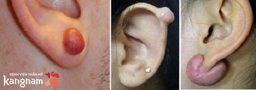 Các dạng sẹo lồi ở tai sẹo lồi ở tai