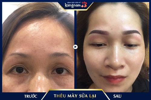 sửa lông mày hỏng