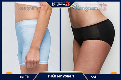 Vòng 3 căng đầy sau khi thực hiện độn mông bằng chất liệu chuyên dụng tại sao mông bị hóp 2 bên