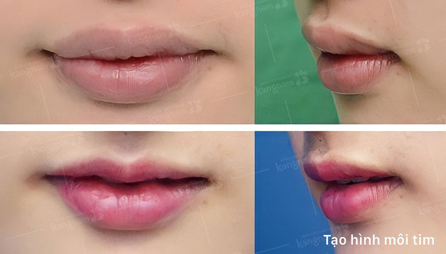 Tạo hình môi trái tim tại Kangnam