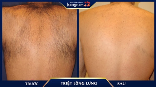 Triệt toàn bộ lông vùng lưng trả lại làn da sáng mịn, đều màu cho khách hàng tẩy lông lưng