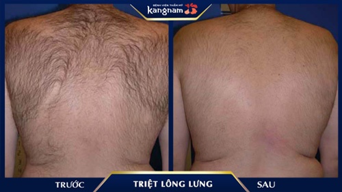 Sau 1 - 2 lần triệt lông (trong tổng liệu trinh 5 lần), lông ở lưng đã được khắc phục đáng kể, gần như chỉ còn lại những sợi lông tơ mảnh tẩy lông ở lưng