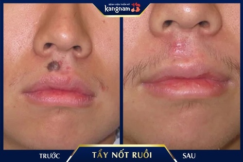 Nốt ruồi to được loại bỏ hoàn toàn sau trị liệu bằng laser làm mờ nốt ruồi bằng kem đánh răng