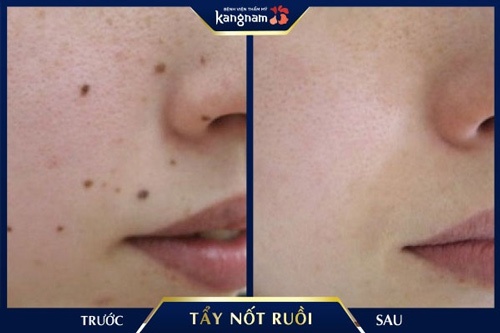 Xóa sạch tình trạng mụn ruồi li ti mọc nhiều trên mặt xóa nốt ruồi bằng kem đánh răng